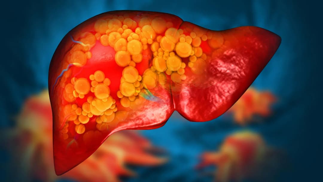 New drug reverses severe fatty liver disease by repairing the gut - Science Daily